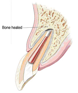 Apicoectomy