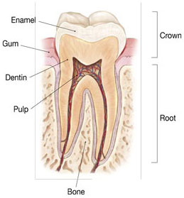 Cracked Tooth